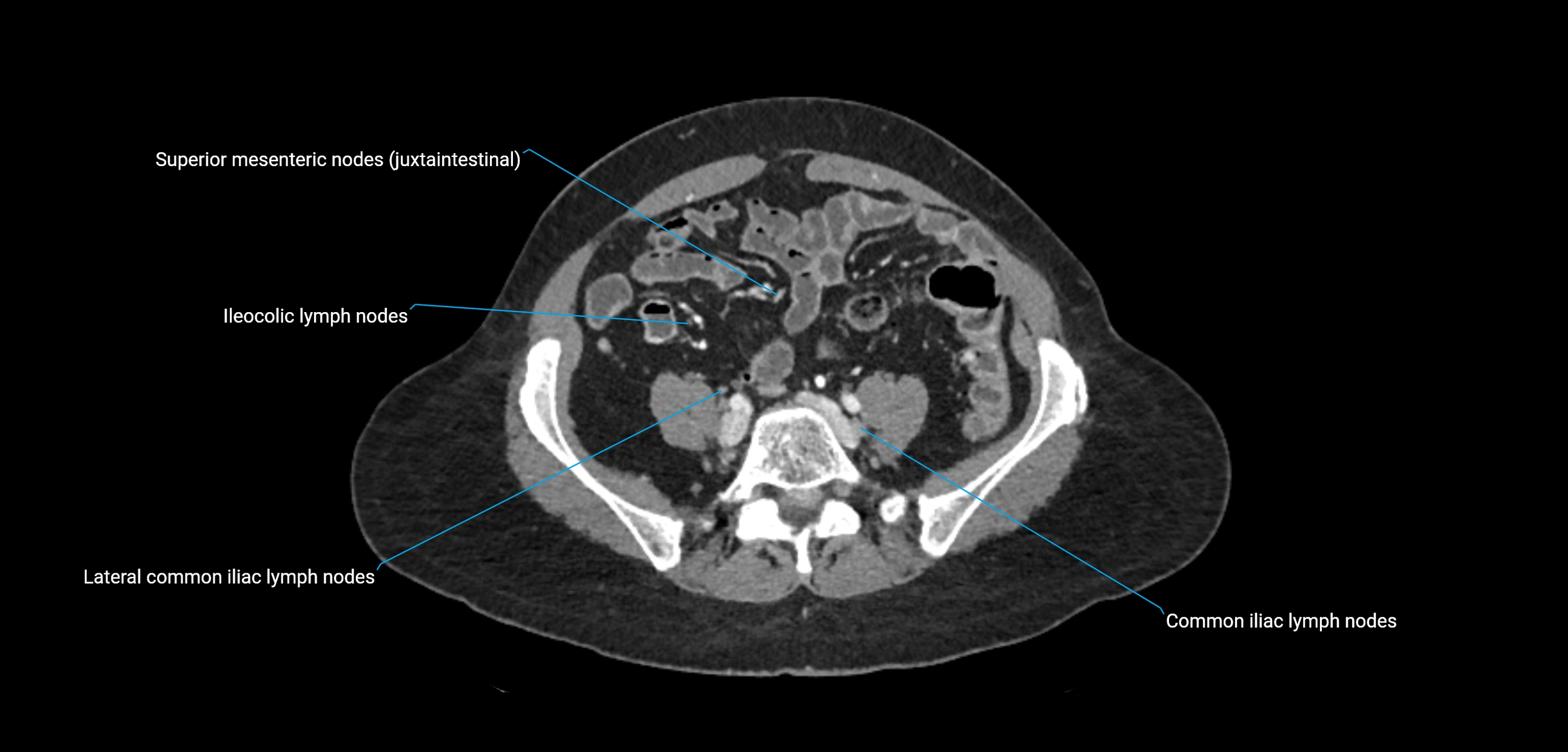 CT ct abdominal lymph nodes  axial cross sectional anatomy  enchanced radiology image -img-00002-00301.webp